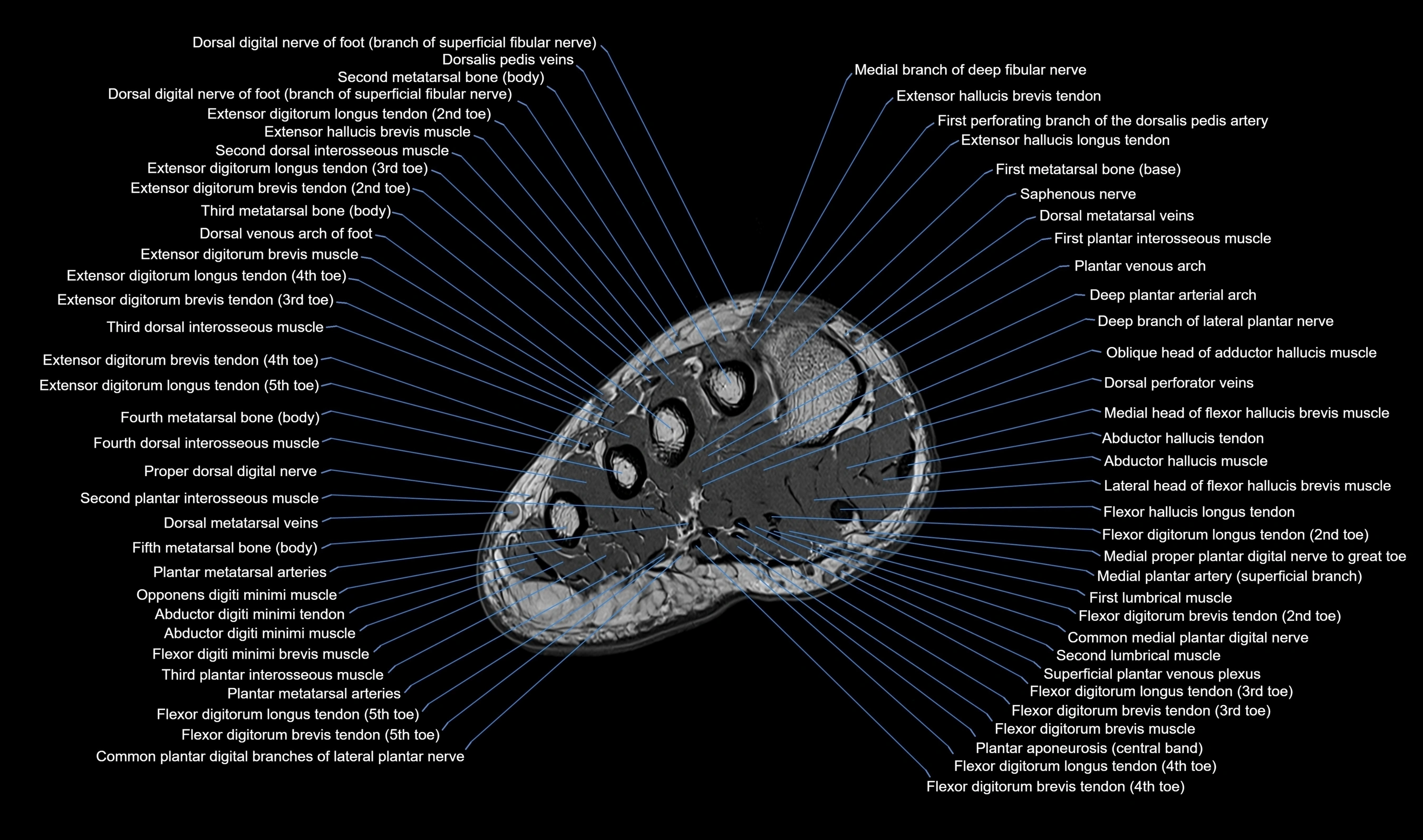 MRI mid foot axial cross sectional anatomy 3T  radiology  image-img-00001-00007.webp
